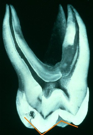 I overkæben omfatter den funktionelle
oklusalflade også en del af lingualfladen.
Emaljeoverflader og emaljetykkelse.