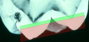 Emaljetykkelsen er størst der hvor tanden under
normale omstændigheder slides mest