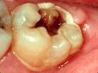 Alvorligt cariesangreb