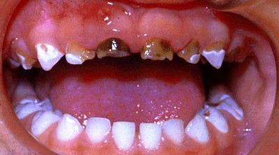 Sutteflaskecaries? Såsnart tænderne udsættes for
tilstrækkelige mekaniske påvirkninger vil de mest
svækkede dele af tanden knække af og blive slidt væk.
Caries standses.