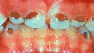 Sutteflaskecaries? Caries langs gingiva.
Standset caries på andre flader.