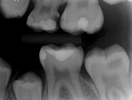 -7 defekt der ikke skyldes caries