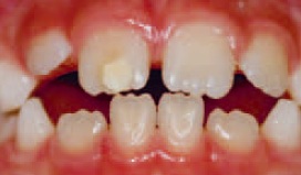 Tænder før slid, Tandlægebladet 2011, side 1042