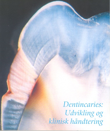 Forsiden af Tandlægebladet illustrerer snit gennem carieret tand
(subsurface lesion).