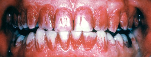 Tre uger uden tandbørstning. Plak på tænderne farvet rødt.
Else Theilade.