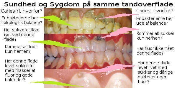 Sundhed og sygdom på samme tandoverflade
