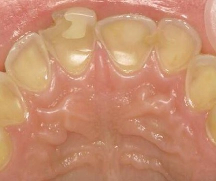 Erosioner, syreskader er kun mulige hvis
de suppleres med mekanisk påvirkning.