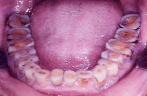 Oclusivon and Attrition of the Primitive Yanomami Indians of Brazil.
Cléber Bidegain Pereira, Harry Evans
Publiched in Dental Clinics of North America -
Symposium on an Alterable Centric Relation in Dentistry - V.19, N. 3, July 1975